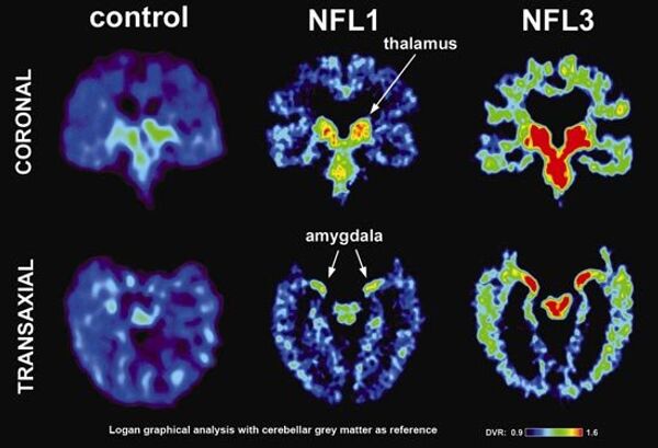 Scan showing a healthy brain and two scans from professional football players with a brain disease called CTE - Sputnik International